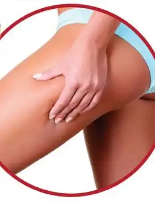 profound ile selulit tedavisi 2