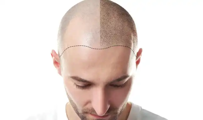 sac ve sakal ekimi hakkinda hersey